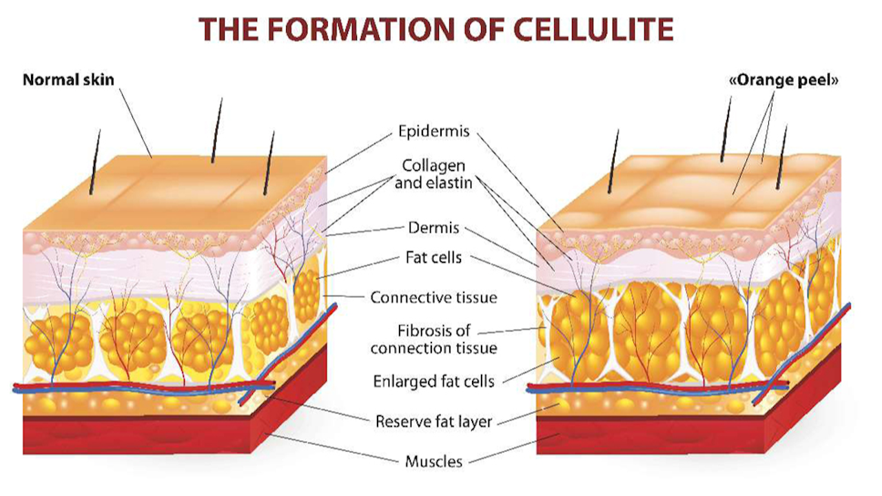 Treating And Understanding Cellulite Wellspa 360 Treating And Understanding Cellulite Wellspa 360