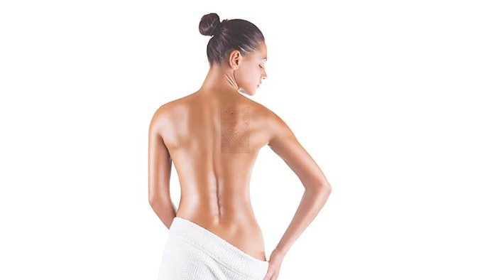 Ds2106 Spotlight Body Acne Dreamstime 35806039 W 850np