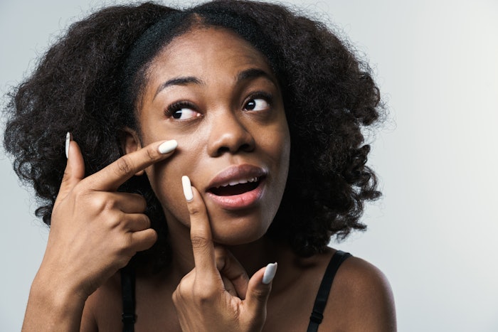 Of those respondents suffering from acne, more than 70% had received negative comments about their condition/appearance. And 40% had been suffering the condition for more than 10 years. Furthermore, nearly 74% suffered from post-inflammatory hyperpigmentation.